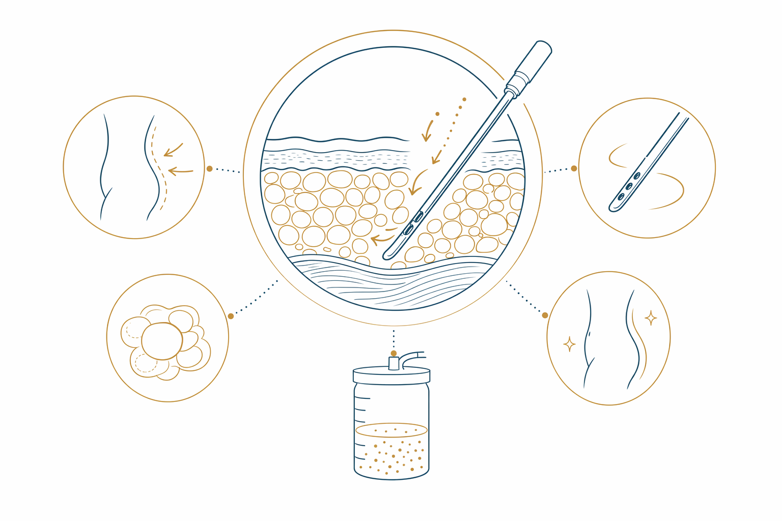 What liposuction is